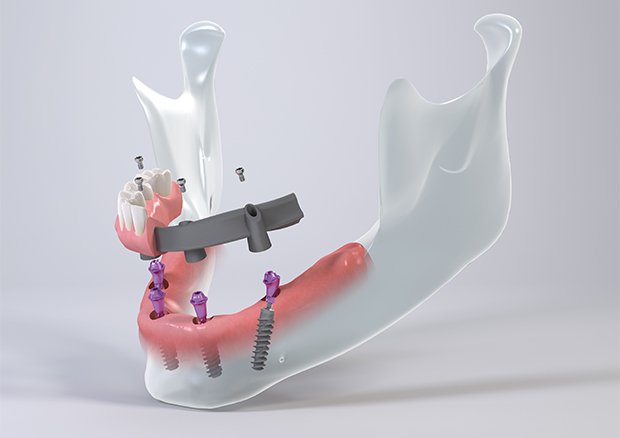 無歯顎でお悩みの方へ最適なインプラント治療<