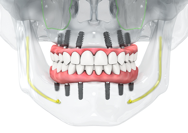 精密な治療をサポートする口腔内スキャナー「iTero(アイテロ)」