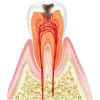 中度のむし歯C2