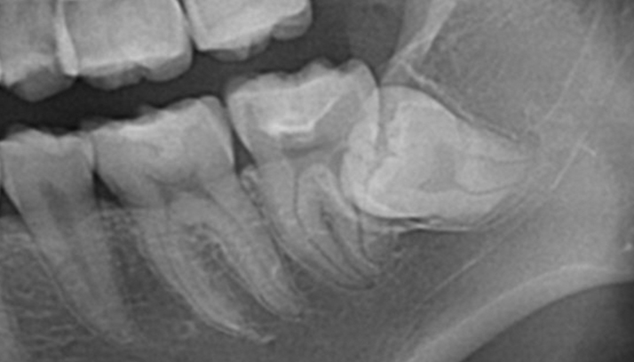 痛みが少ない親知らずの抜歯