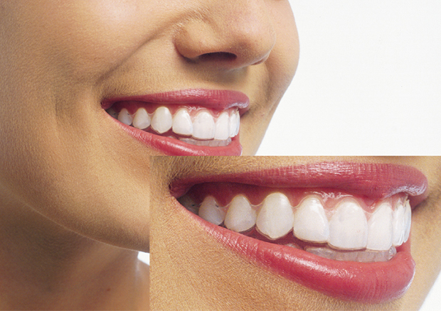 取り外し可能で目立たないマウスピース矯正