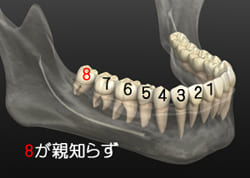 親知らずで悩んでいませんか?
