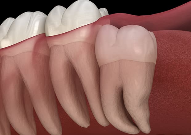 真っ直ぐ生えている親知らず