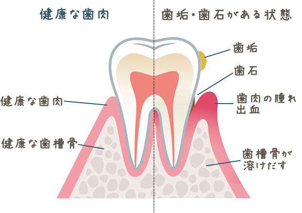 歯周病を放置させると歯を失う原因になります